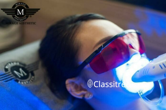 led-teeth-whitening-treatment-in-singapore-mirage-aesthetic-big-0
