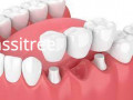dental-bridge-cost-singapore-tanjong-pagar-dental-clinic-small-0