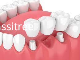dental-bridge-cost-singapore-tanjong-pagar-dental-clinic-big-0