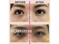 Best Eye Bag Removal Treatment in Singapore Healthsprings Ae