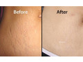 Contrary Ways For Stretch Marks Removal by beautirecipie