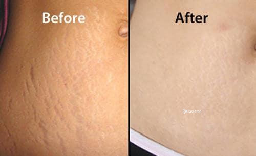 contrary-ways-for-stretch-marks-removal-by-beautirecipie-big-0