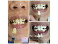  PROMO Price Casabella Punggol Teeth Whitening Homebased